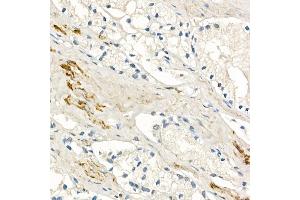 Immunohistochemistry of paraffin-embedded human prostate cancer using MMP7 Rabbit mAb (ABIN7268425) at dilution of 1:150 (40x lens). (MMP7 抗体)
