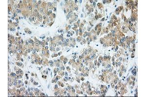 Immunohistochemical staining of paraffin-embedded Adenocarcinoma of Human ovary tissue using anti-H6PD mouse monoclonal antibody. (Glucose-6-Phosphate Dehydrogenase 抗体)