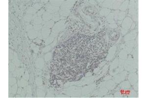 Immunohistochemistry (IHC) analysis of paraffin-embedded Human Breast Carcinoma using TNF a Rabbit Polyclonal Antibody diluted at 1:200. (TNF alpha 抗体)