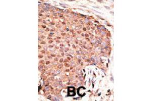 Formalin-fixed and paraffin-embedded human cancer tissue reacted with ZMIZ1 polyclonal antibody  , which was peroxidase-conjugated to the secondary antibody, followed by AEC staining. (ZMIZ1 抗体  (C-Term))