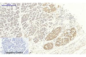 Immunohistochemical analysis of paraffin-embedded human stomach cancer tissue.