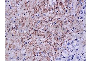Formalin-fixed and paraffin embedded human prostate tissue labeled with Anti-Androgen receptor Polyclonal Antibody, Unconjugated (ABIN725240) at 1:200, followed by conjugation to the secondary antibody and DAB staining (Androgen Receptor 抗体  (AA 825-919))