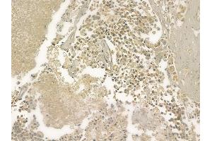 ABIN6261019 and ABIN6273216 at 1/100 staining human prostate carcinoma by IHC-P. (CRAT 抗体  (N-Term))