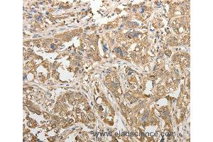 Immunohistochemistry of Human esophagus cancer using ADHFE1 Polyclonal Antibody at dilution of 1:50 (ADHFE1 抗体)