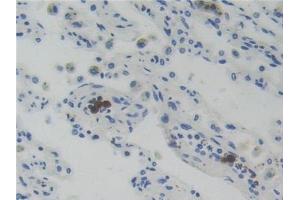 Detection of GR in Human Lung cancer Tissue using Polyclonal Antibody to Glucocorticoid Receptor (GR) (Glucocorticoid Receptor 抗体  (AA 598-755))