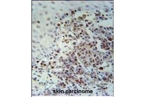 XRCC1 Antibody (Center) (ABIN651735 and ABIN2840381) immunohistochemistry analysis in formalin fixed and paraffin embedded human skin carcinoma followed by peroxidase conjugation of the secondary antibody and DAB staining.