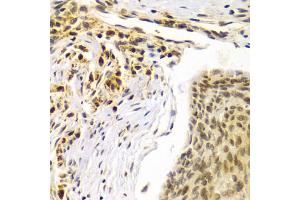 Immunohistochemistry of paraffin-embedded human esophageal cancer using SMARCE1 Antibody (ABIN5973097) at dilution of 1/100 (40x lens). (SMARCE1 抗体)