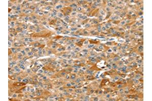 The image on the left is immunohistochemistry of paraffin-embedded Human liver cancer tissue using ABIN7129263(DSTYK Antibody) at dilution 1/25, on the right is treated with fusion protein. (DSTYK 抗体)