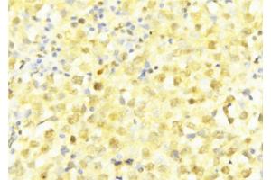 ABIN6277600 at 1/100 staining Human breast cancer tissue by IHC-P. (LITAF 抗体  (Internal Region))