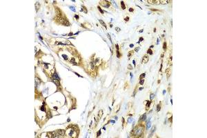 Immunohistochemistry of paraffin-embedded human liver cancer using TMOD4 antibody (ABIN5974100) at dilution of 1/100 (40x lens). (Tropomodulin 4 抗体)