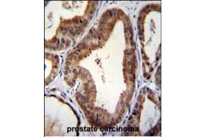 SHQ1 Antibody (N-term) (ABIN655661 and ABIN2845133) immunohistochemistry analysis in formalin fixed and paraffin embedded human prostate carcinoma followed by peroxidase conjugation of the secondary antibody and DAB staining. (SHQ1 抗体  (N-Term))