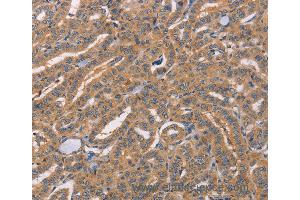 Immunohistochemistry of Human lung cancer using CDCA4 Polyclonal Antibody at dilution of 1:50