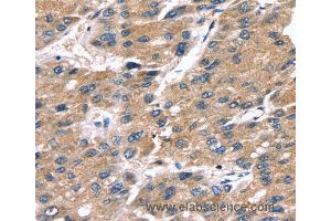 Immunohistochemistry of Human liver cancer using SRGN Polyclonal Antibody at dilution of 1:25 (SRGN 抗体)