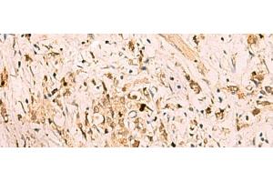 Immunohistochemistry of paraffin-embedded Human gastric cancer tissue using SGTA Polyclonal Antibody at dilution of 1:75(x200) (SGTA 抗体)