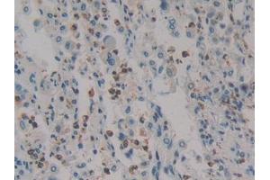 DAB staining on IHC-P; Samples: Human Lung cancer Tissue (HMGXB4 抗体  (AA 264-540))