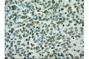 Immunohistochemical staining of paraffin-embedded Adenocarcinoma of breast tissue using anti-SILV mouse monoclonal antibody. (Melanoma gp100 抗体)