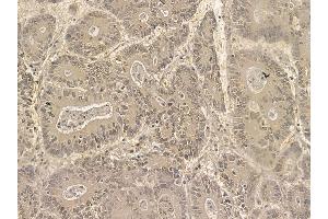FAM114A2 Mouse Monoclonal Antibody at 1/100 staining human colorectal cancer by IHC-P. (FAM114A2 抗体)