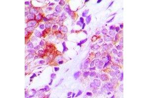 Immunohistochemical analysis of MRP1 staining in human lung cancer formalin fixed paraffin embedded tissue section.