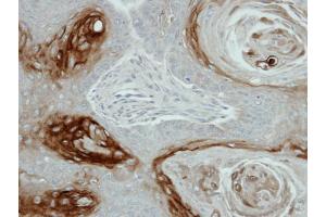 IHC-P Image Immunohistochemical analysis of paraffin-embedded Cal27 xenograft, using KLK7, antibody at 1:100 dilution. (Kallikrein 7 抗体)