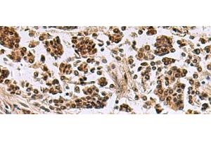 Immunohistochemistry of paraffin-embedded Human breast cancer tissue using SIK3 Polyclonal Antibody at dilution of 1:60(x200) (SIK3 抗体)