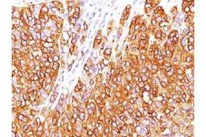 IHC testing of human melanoma stained with MART-1 antibody (M2-7C10).