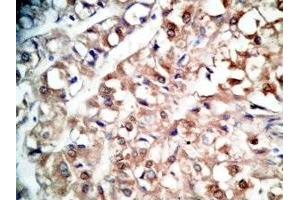 Human kidney cancer tissue was stained by rabbit Anti-BNP-45 (Mouse) Antiserum (BNP-45 抗体  (AA 51-95))
