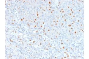 Formalin-fixed, paraffin-embedded human Bladder Carcinoma stained with Annexin A1 Mouse Monoclonal Antibody (6E4/3). (Annexin a1 抗体)