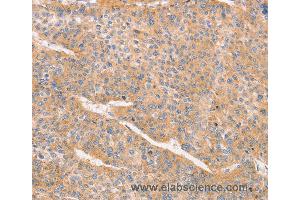 Immunohistochemistry of Human liver cancer using CD2AP Polyclonal Antibody at dilution of 1:70 (CD2AP 抗体)
