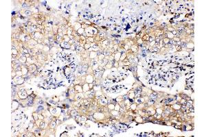 GAPDH was detected in paraffin-embedded sections of human lung cancer tissues using rabbit anti- GAPDH Antigen Affinity purified polyclonal antibody (Catalog # ) at 1 µg/mL.