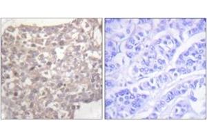 Immunohistochemistry analysis of paraffin-embedded human breast carcinoma tissue, using Tubulin gamma Antibody. (TUBG1 抗体  (AA 386-435))