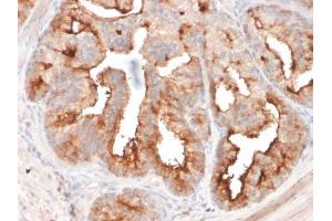 Formalin-fixed, paraffin-embedded human Prostate Carcinoma stained with FOLH1 Mouse Monoclonal Antibody (FOLH1/2354). (PSMA 抗体  (AA 232-433))