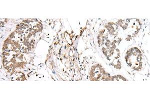 Immunohistochemistry of paraffin-embedded Human esophagus cancer tissue using BAG2 Polyclonal Antibody at dilution of 1:40(x200) (BAG2 抗体)