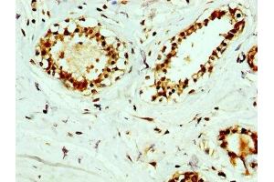 IHC image of ABIN7167302 diluted at 1:400 and staining in paraffin-embedded human breast cancer performed on a Leica BondTM system.