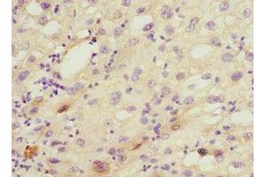 Immunohistochemistry of paraffin-embedded human liver cancer using ABIN7149242 at dilution of 1:100 (CYP2C18 抗体  (AA 231-490))