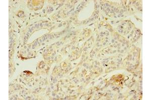 Immunohistochemistry of paraffin-embedded human breast cancer using ABIN7176718 at dilution of 1:100 (AZGP1 抗体  (AA 61-210))