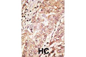Formalin-fixed and paraffin-embedded human hepatocellular carcinoma tissue reacted with TDGF1 polyclonal antibody  , which was peroxidase-conjugated to the secondary antibody, followed by AEC staining. (TDGF1 抗体  (N-Term))