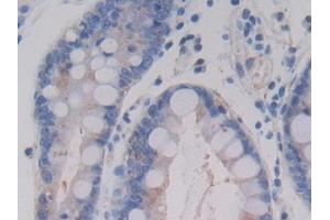 Detection of AMH in Human Stomach cancer Tissue using Monoclonal Antibody to Anti-Mullerian Hormone (AMH) (AMH 抗体)