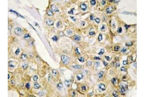 Immunohistochemistry analyzes of DAPP1 antibody in paraffin-embedded human breast carcinoma tissue. (DAPP1 抗体)