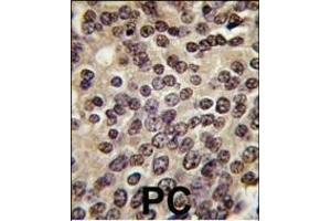 Formalin-fixed and paraffin-embedded human prostata carcinoma tissue reacted with PKN beta antibody (C-term), which was peroxidase-conjugated to the secondary antibody, followed by DAB staining. (PKN beta 抗体  (C-Term))