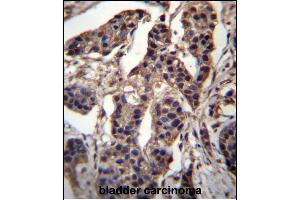 CABIN486182 and ABIN1535563 Antibody (N-term) (ABIN657088 and ABIN2837891) immunohistochemistry analysis in formalin fixed and paraffin embedded human bladder carcinoma followed by peroxidase conjugation of the secondary antibody and DAB staining. (C7ORF25 抗体  (N-Term))