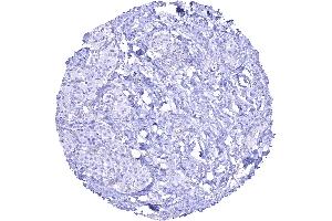 SDH deficient paraganglioma lacking granular SDHB staining in all tumor cells while stroma cells are positive. (Recombinant SDHB 抗体)