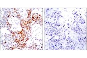 Immunohistochemistry analysis of paraffin-embedded human breast carcinoma, using ATF2 (Phospho-Thr69 or 51) Antibody. (ATF2 抗体  (pSer69))