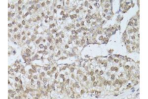 Immunohistochemistry of paraffin-embedded human breast cancer using ESR1 antibody. (Estrogen Receptor alpha 抗体  (AA 1-190))
