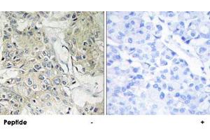 Immunohistochemistry analysis of paraffin-embedded human breast carcinoma tissue, using ANO9 polyclonal antibody .
