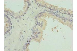 Immunohistochemistry of paraffin-embedded human prostate cancer using ABIN7156409 at dilution of 1:100 (Integrator Complex Subunit 14 (INTS14) (AA 231-518) 抗体)