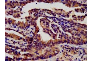 IHC image of ABIN7152837 diluted at 1:450 and staining in paraffin-embedded human lung cancer performed on a Leica BondTM system. (FGFR3 抗体  (AA 23-375))