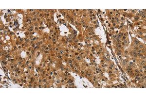 Immunohistochemistry of paraffin-embedded Human gasrtic cancer tissue using PTK6 Polyclonal Antibody at dilution 1:40 (PTK6 抗体)