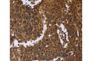 Immunohistochemistry of Human cervical cancer using FGFRL1 Polyclonal Antibody at dilution of 1:40 (FGFRL1 抗体)