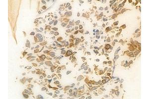 ABIN6265557 and ABIN6278407 at 1/100 staining human lung squamous cell carcinoma by IHC-P. (THOC1 抗体  (C-Term))