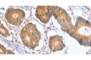 Immunohistochemistry of paraffin-embedded Human colon cancer tissue using BLNK Polyclonal Antibody at dilution 1:50 (B-Cell Linker 抗体)